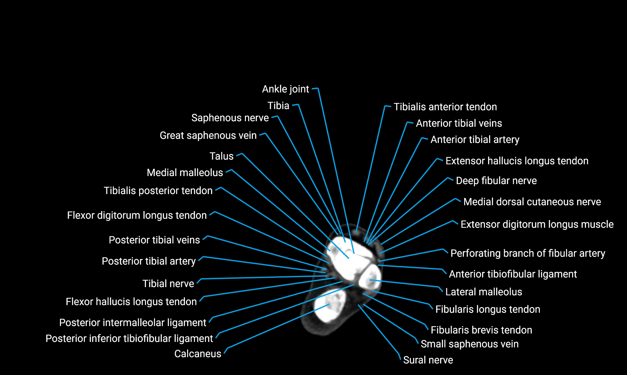 CT lower limb axial cross sectional anatomy labelled image 166 (2).webp